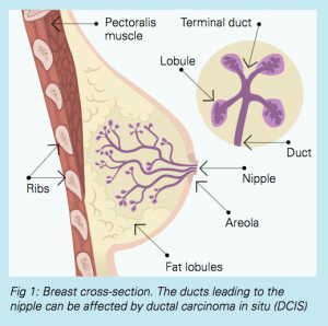 breast cancer cells diagram