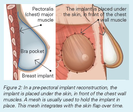 BreastReconstruct_fig2