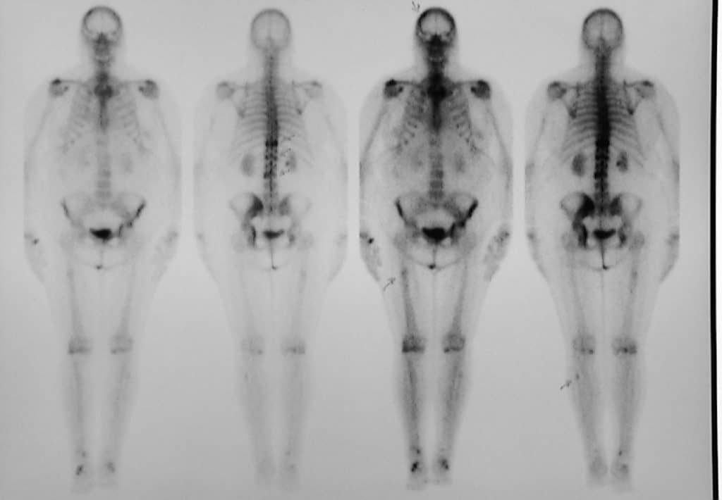 metastatic-bone-disease-fact-sheet-westmead-bci