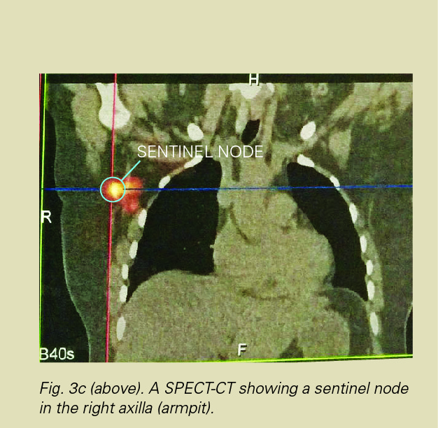 neoprobe sentinel node biopsy